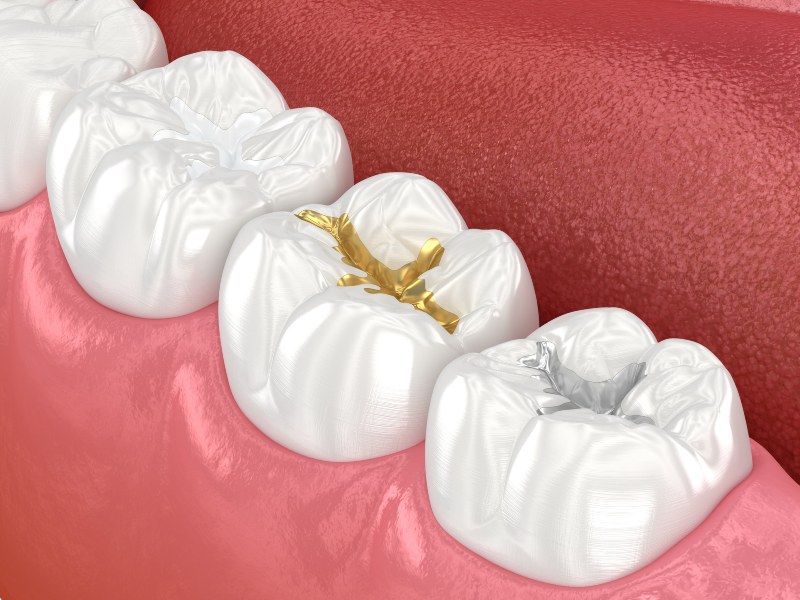 Graphical representation of how dental sealants safeguard your teeth in Moberly, MO