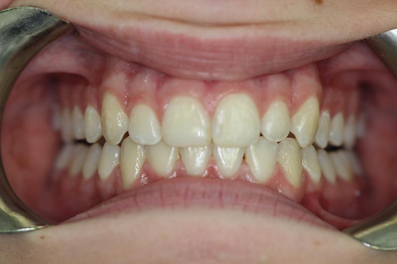 after orthodontics
