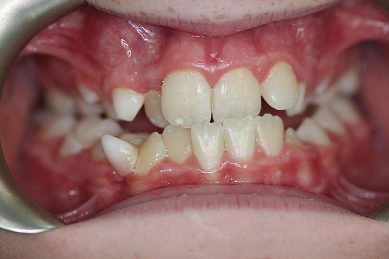 before orthodontics